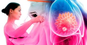 MIT revoluciona la detección temprana del cáncer de mama con Inteligencia Artificial